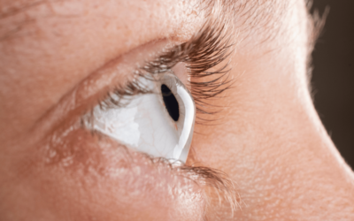 What are the Best Contact Lenses for Keratoconus?